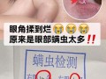 眼睛里有螨虫的症状以及治疗，眼睛里有螨虫什么症状