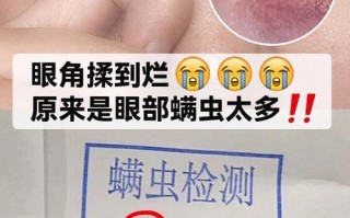 眼睛里有螨虫的症状以及治疗，眼睛里有螨虫什么症状
