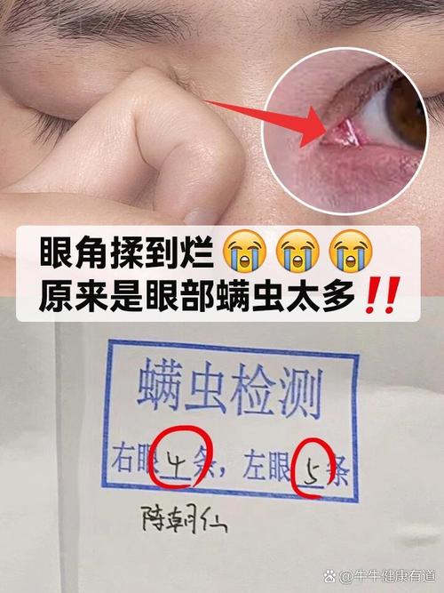 眼睛里有螨虫的症状以及治疗,眼睛里有螨虫什么症状-第1张图片 眼睛里有螨虫的症状以及治疗,眼睛里有螨虫什么症状-第1张图片