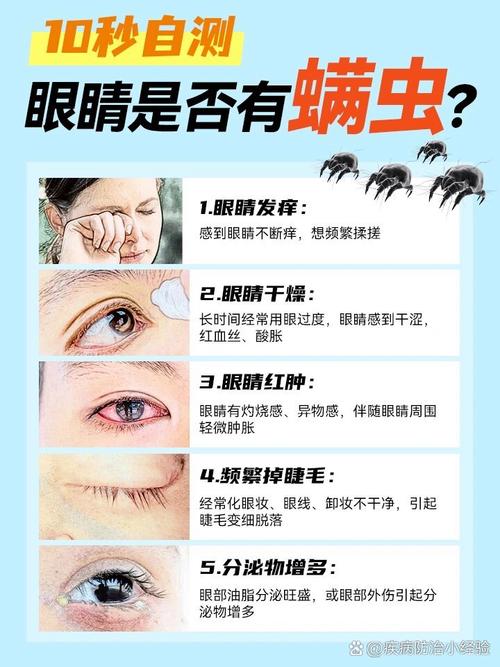眼睛里有螨虫的症状以及治疗,眼睛里有螨虫什么症状-第3张图片 眼睛里有螨虫的症状以及治疗,眼睛里有螨虫什么症状-第3张图片